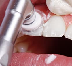 PMCT(Professional Mechanical Tooth Cleaning)