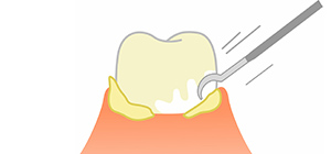 1.歯周ポケットに潜む歯石を除去できます
